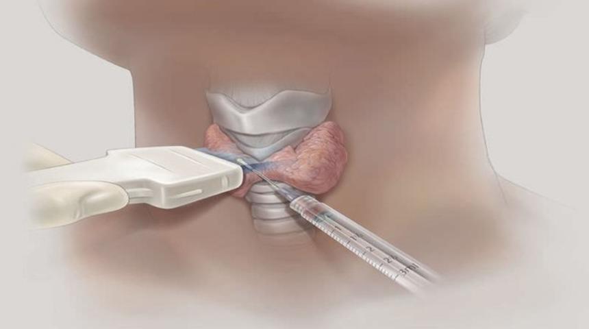 Tiroid nod&uuml;llerinde iğne biyopsisi