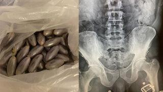 Hepsi midesindeydi: Tam 100 adet! Hastaneye götürülünce ortaya çıktı