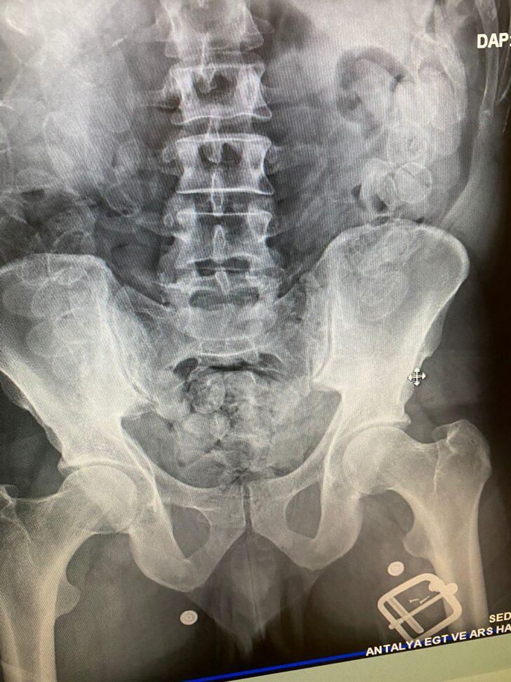 Antalya'da midesinden 100 kapsül esrar çıkan yabancı uyruklu şüpheli yakalandı G2