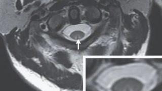 Sadece gülmek istemişti! Gülme gazı nedeniyle yürüyememeye başladı