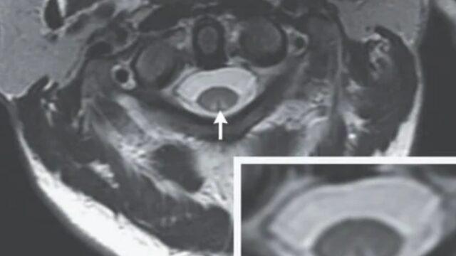 Sadece gülmek istemişti! Gülme gazı nedeniyle yürüyememeye başladı