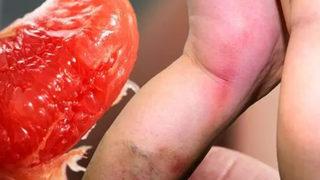 Her gün yediği meyve yüzünden neredeyse bacağını kaybediyordu