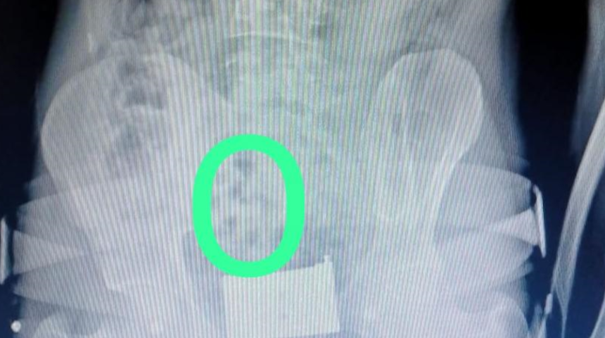 Polis, şüphelendi! Çekilen röntgende her şey ortaya çıktı... Kapsül haline getirip yutmuşlar