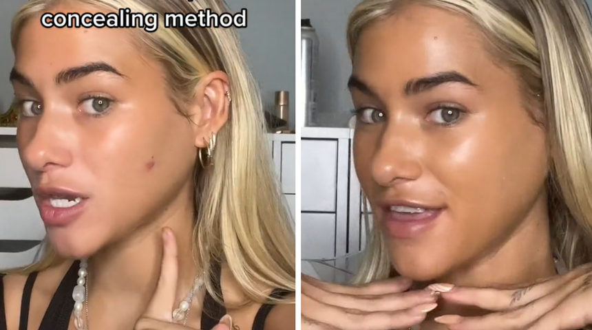 TikTok'ta paylaştı: Makyajla bile kapanmayan büyük sivilceleri anında silecek yöntem!  Sivilceler nasıl kapatılır?