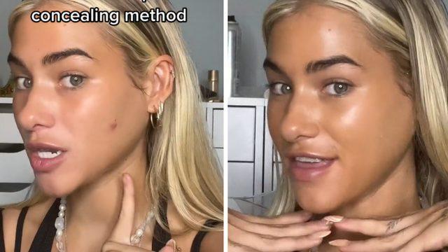 TikTok'ta paylaştı: Makyajla bile kapanmayan büyük sivilceleri anında silecek yöntem!  Sivilceler nasıl kapatılır?