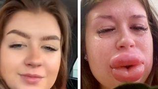 Hayatının hatasını yaptı! Dudak dolgusu yüzünden başına gelenler dehşete düşürdü