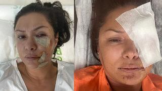 Şarkıcı Tuğba Altıntop köpek saldırısına uğradı! Yüzüne dikiş atıldı