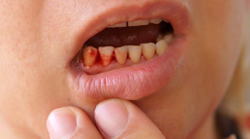 Diş sağlığını önemsiz görmeyin: Öyle bir hastalığa sebep oluyor ki... Çok şaşıracaksınız