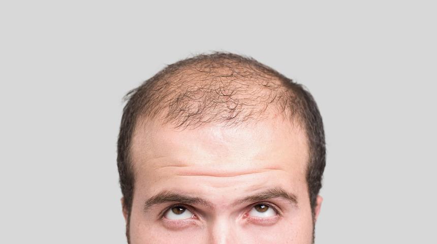 Saç dökülmesini hızlandırıyor, kelliğe neden oluyor, saç derisini tahriş ediyor! Kesinlikle uzak durun