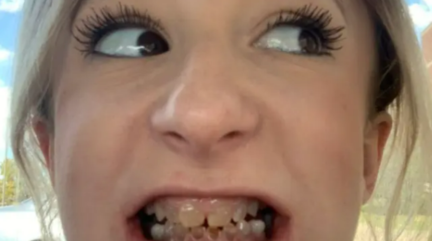 Böylesi görülmedi! Doğuştan şeffaf dişleri nedeniyle yıllarca gülemedi