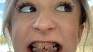 Böylesi görülmedi! Doğuştan şeffaf dişleri nedeniyle yıllarca gülemedi