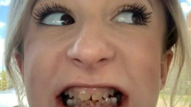 Böylesi görülmedi! Doğuştan şeffaf dişleri nedeniyle yıllarca gülemedi