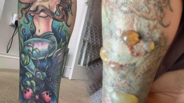 Yaptırmadan önce bir kez daha düşünün! Dövme sildirmenin bilinmeyen yüzü