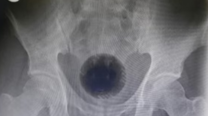 Evde hemoroid tedavisi yapmaya çalışan adamın anüsünden çıkan şok etkisi yarattı