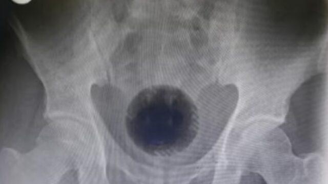 Evde hemoroid tedavisi yapmaya çalışan adamın anüsünden çıkan şok etkisi yarattı