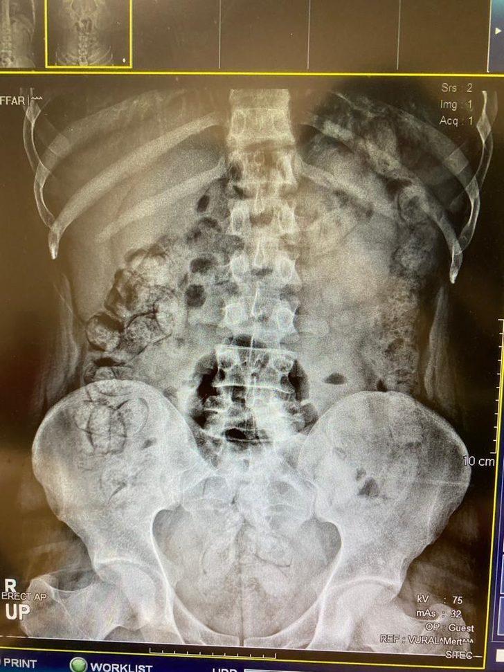 İran uyruklu 5 şüphelinin vücudundan 683 kapsül uyuşturucu çıktı G3