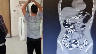 Polis hareketlerinden şüphelendi, röntgendeki görüntü şoke etti! Midelerinden tam 683 tane çıktı