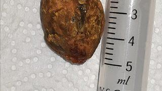 Safra kesesinden 3 santimetrelik taş çıktı