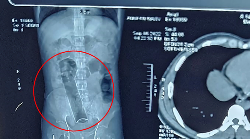 Anüsüne soktuğu madde dehşete düşürdü! Deodorant şişesi haftalarca içinde kaldı