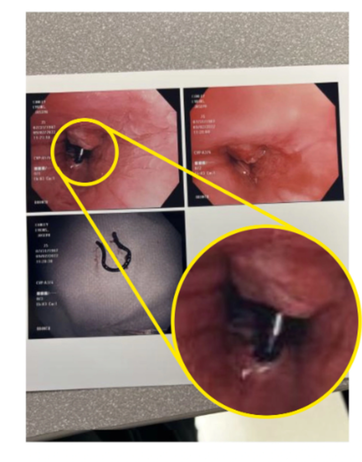 5 yıl önce burun piercingini kaybetti! Bulduğu yere kendisi bile inanamadı G4