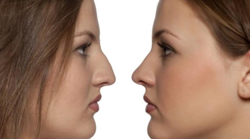 Burun estetiğinin doğal g&ouml;r&uuml;nmesi i&ccedil;in dikkat edilmesi gerekenler