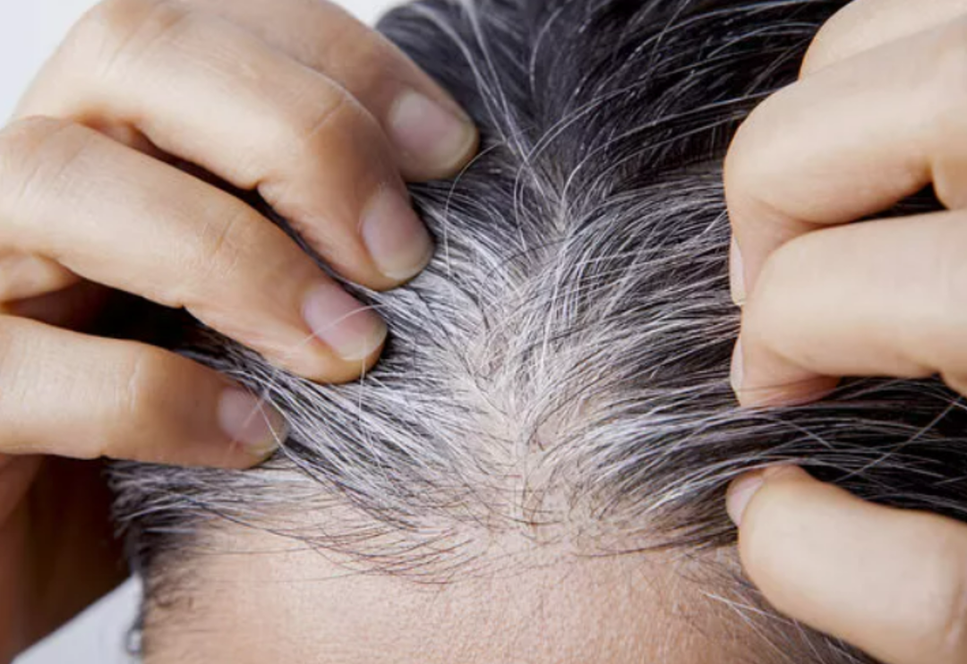 Erken yaşta bembeyaz yapıyor! Sa&ccedil;larınızın beyazlamaması i&ccedil;in bunlardan uzak durun