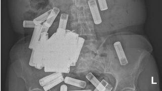 Doktorlar bile şaşırdı! Midesinden ve anüsünden tam 55 tane...