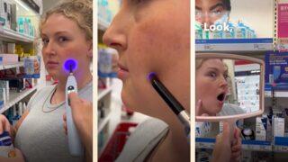 Sivilce izlerinizden çok kısa bir sürede kurtulmanızı sağlayacak iz giderici lazer cihazı