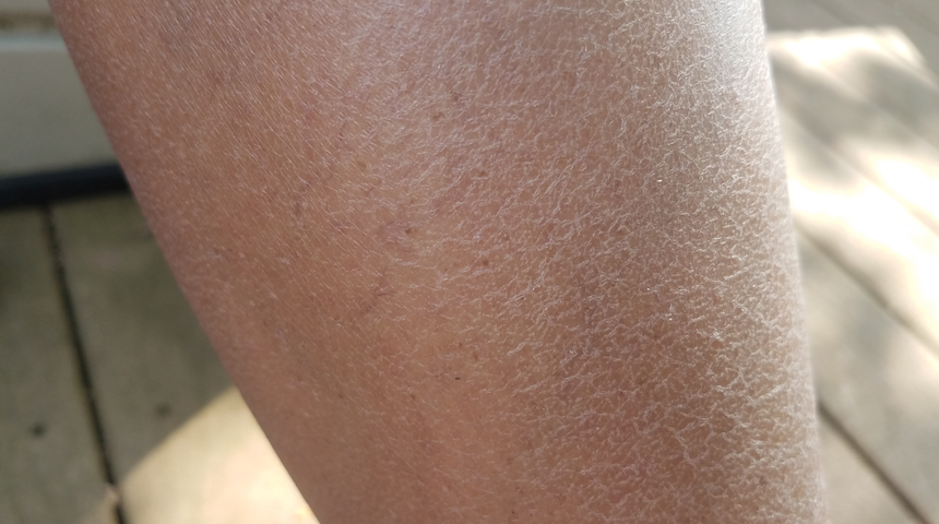 Cilt kuruluğunu basit görmeyin! Sinsi ilerleyen hastalığın büyük belirtisi