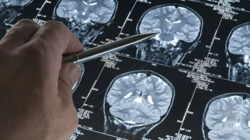 Sürekli olarak "şey" diyorsanız dikkat! Alzheimer riskiniz çok yüksek