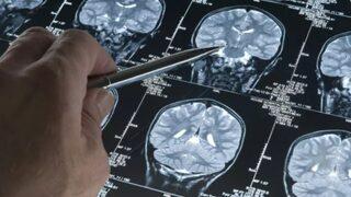 Sürekli olarak şey diyorsanız dikkat! Alzheimer riskiniz çok yüksek