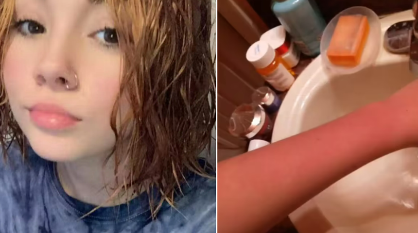 Alerjisi nedeniyle ne duş alabiliyor ne de ağlayabiliyor! Dayanılmaz acılara neden oluyor