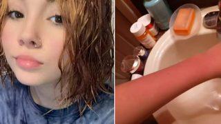 Alerjisi nedeniyle ne duş alabiliyor ne de ağlayabiliyor! Dayanılmaz acılara neden oluyor