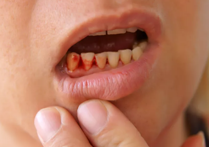 Bu belirtiler varsa durumlar kötüleşmeden önleminizi alın! C vitamini eksikliği belirtileri G5