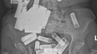 Görenler şaşırıyor: Anüsünden ve midesinden 55 tane pil çıktı! 