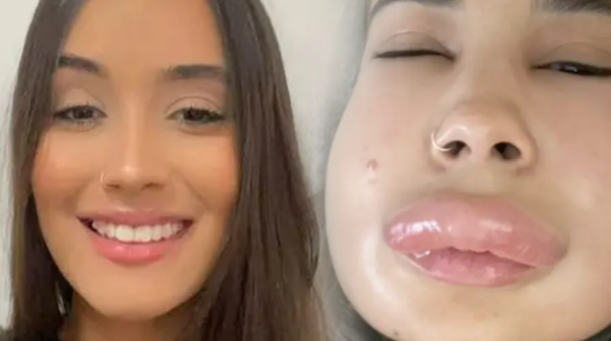 Dermatolog uyardı! Yaptırdığı dudak dolgusu nedeniyle neredeyse ölüyordu