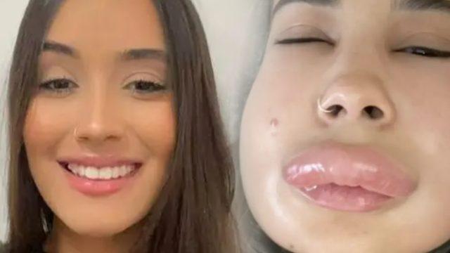 Dermatolog uyardı! Yaptırdığı dudak dolgusu nedeniyle neredeyse ölüyordu