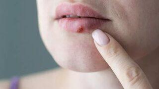 Bağışıklıklar düştü uçuklar artmaya başladı! Uçuğu en kısa sürede geçirmek için etkili yöntem