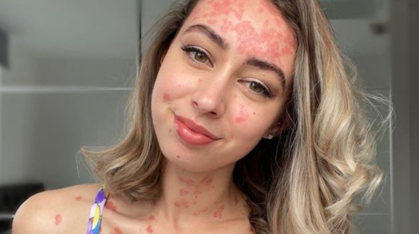 Yıllardır bu hastalıkla savaşıyor! Sedef hastalığının etkilerini iç çamaşırıyla paylaştı