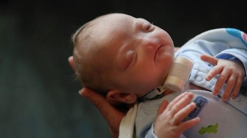 Burnu olmadan doğdu, fenomen haline geldi