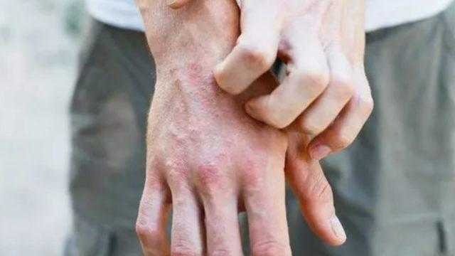 Kaşıntılı egzamalarınız son bulacak! Sorunlarınızı bıçak gibi kesecek 5 öneri