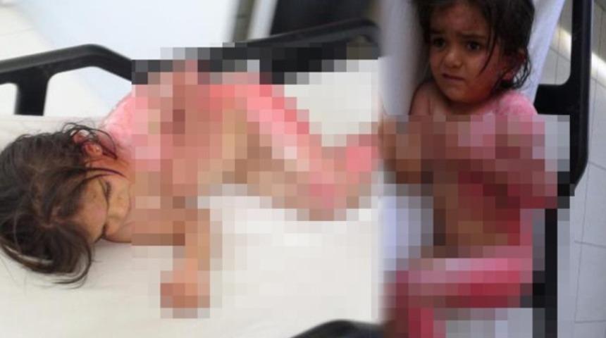 6 yaşındaki Songül'ün üzerine sıcak su kazanı devrildi