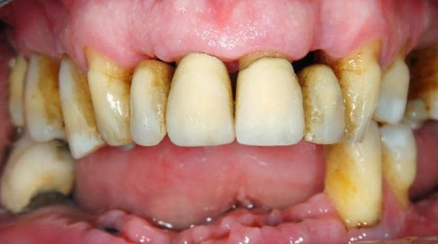 Dişlerinizin bu halde olması sadece ağız sağlığınızı etkilemiyor!