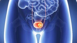 Mesane kanseri hakkında neler biliyorsunuz?