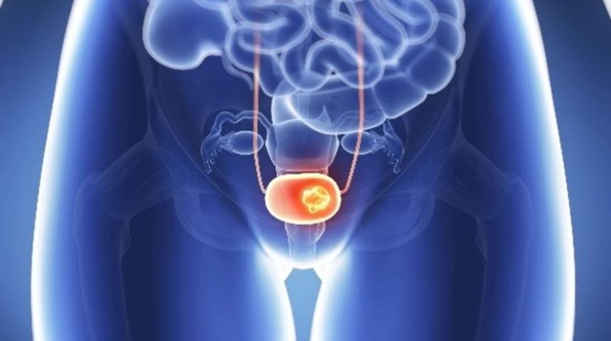 Mesane kanseri hakkında neler biliyorsunuz?