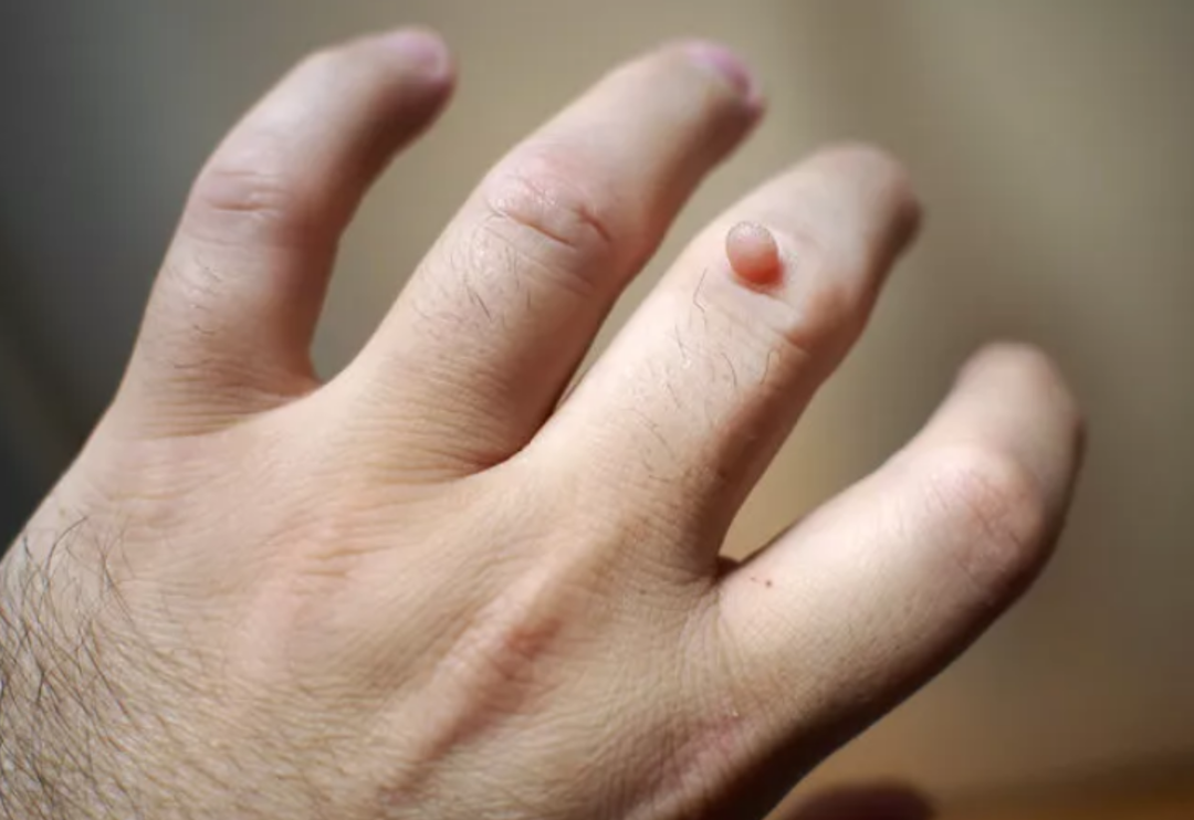 Siğilleri k&ouml;kten kurutacak! D&uuml;zenli kullanımda kurtulmanın yolu &ccedil;ok basit