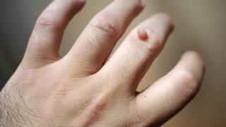 Siğilleri kökten kurutacak! Düzenli kullanımda kurtulmanın yolu çok basit