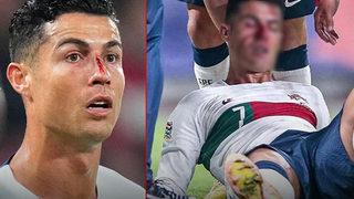 Cristiano Ronaldo'nun antrenmandaki görüntüsü içler acıttı! Yüzü morluk içinde...