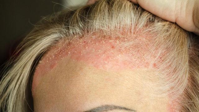 Zararı saymakla bitmiyor: Kaçmak imkânsız, her yerdeler! Ölümcül darbe vuruyor