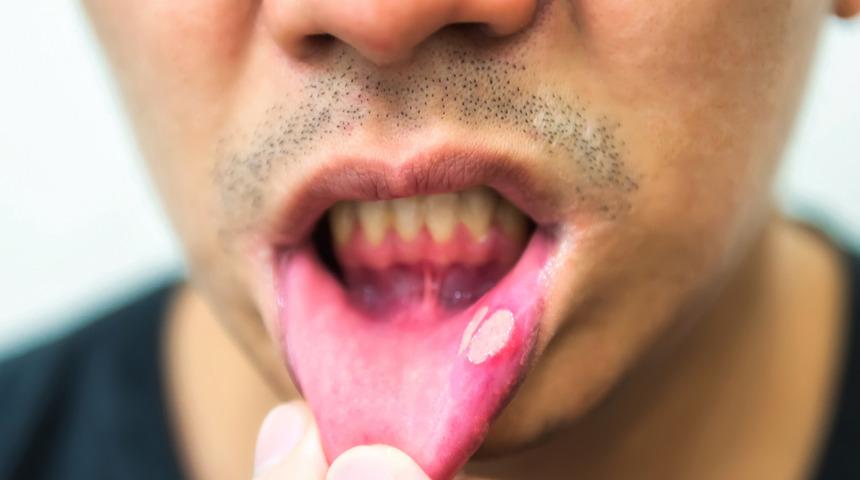 Ağzınızda bunu görüyorsanız büyük risk altındasınız demektir!